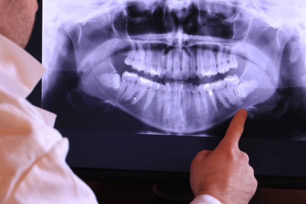 Best Knocked-Out Tooth (Avulsed Tooth) Treatment in Garden City, NY